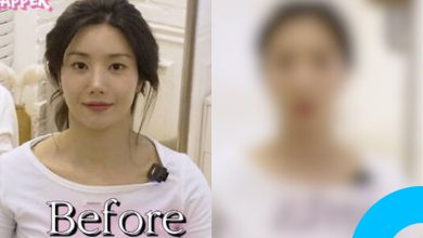 Kwon Eun-bi Reveals Before-and-After Treatment Photos thumbnail