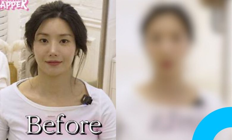 Kwon Eun-bi Reveals Before-and-After Treatment Photos thumbnail