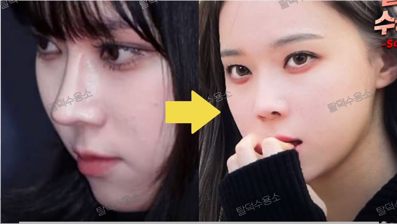 aespa Winter nose surgeryrhinoplasty-before-after-asian-woman-nosejob.