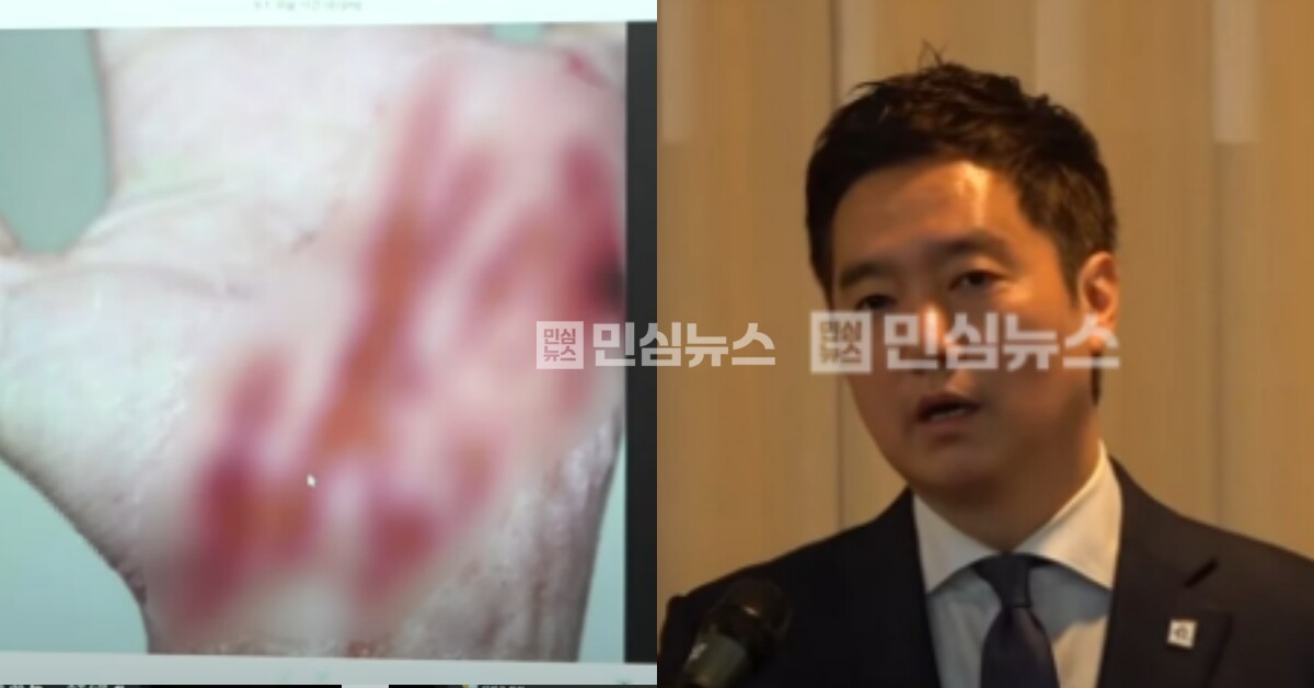 Kim Sae-ron whistleblower FBIhand-burns-presentation-korean-news.